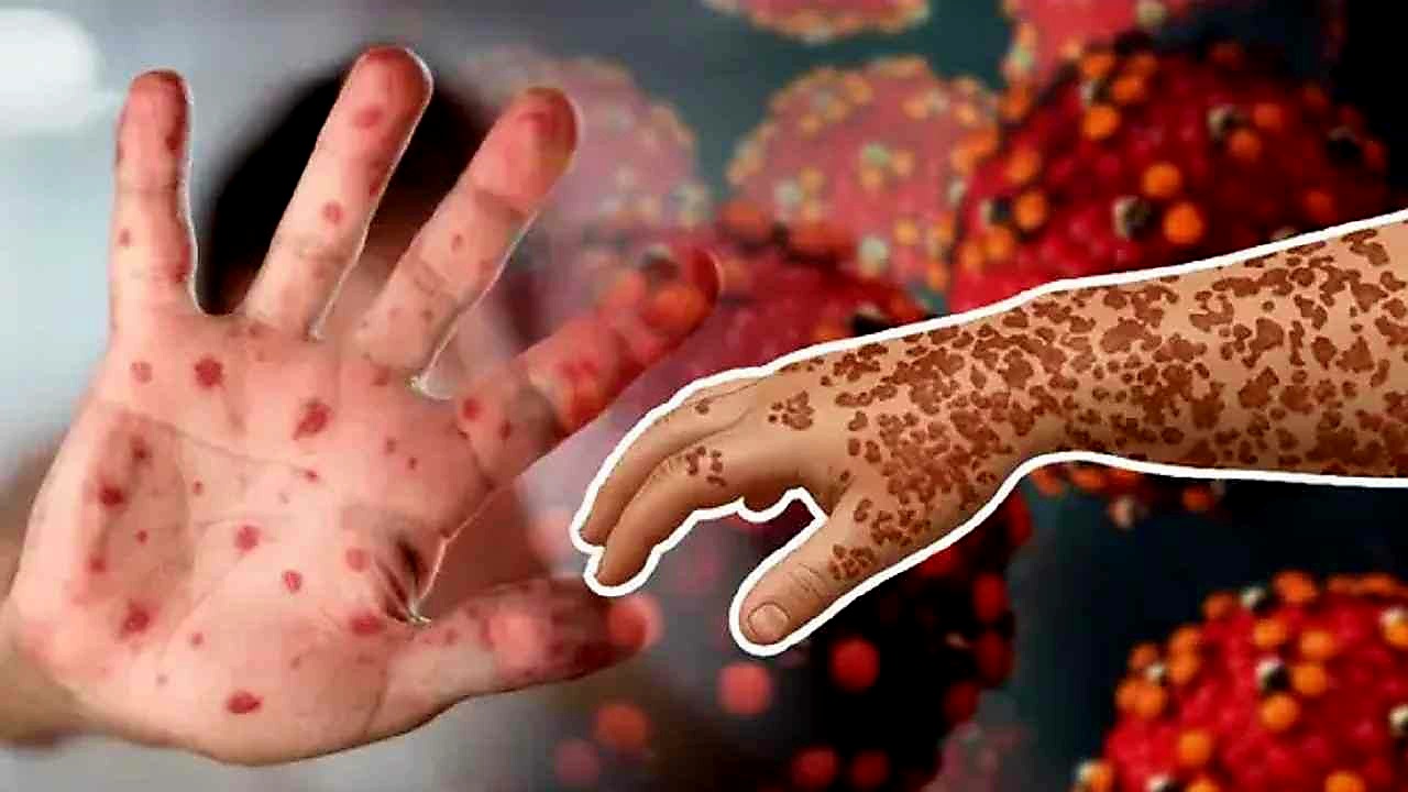 হামে ২৮ দিনে মোট ১৬৯ শিশুর মৃত্যু