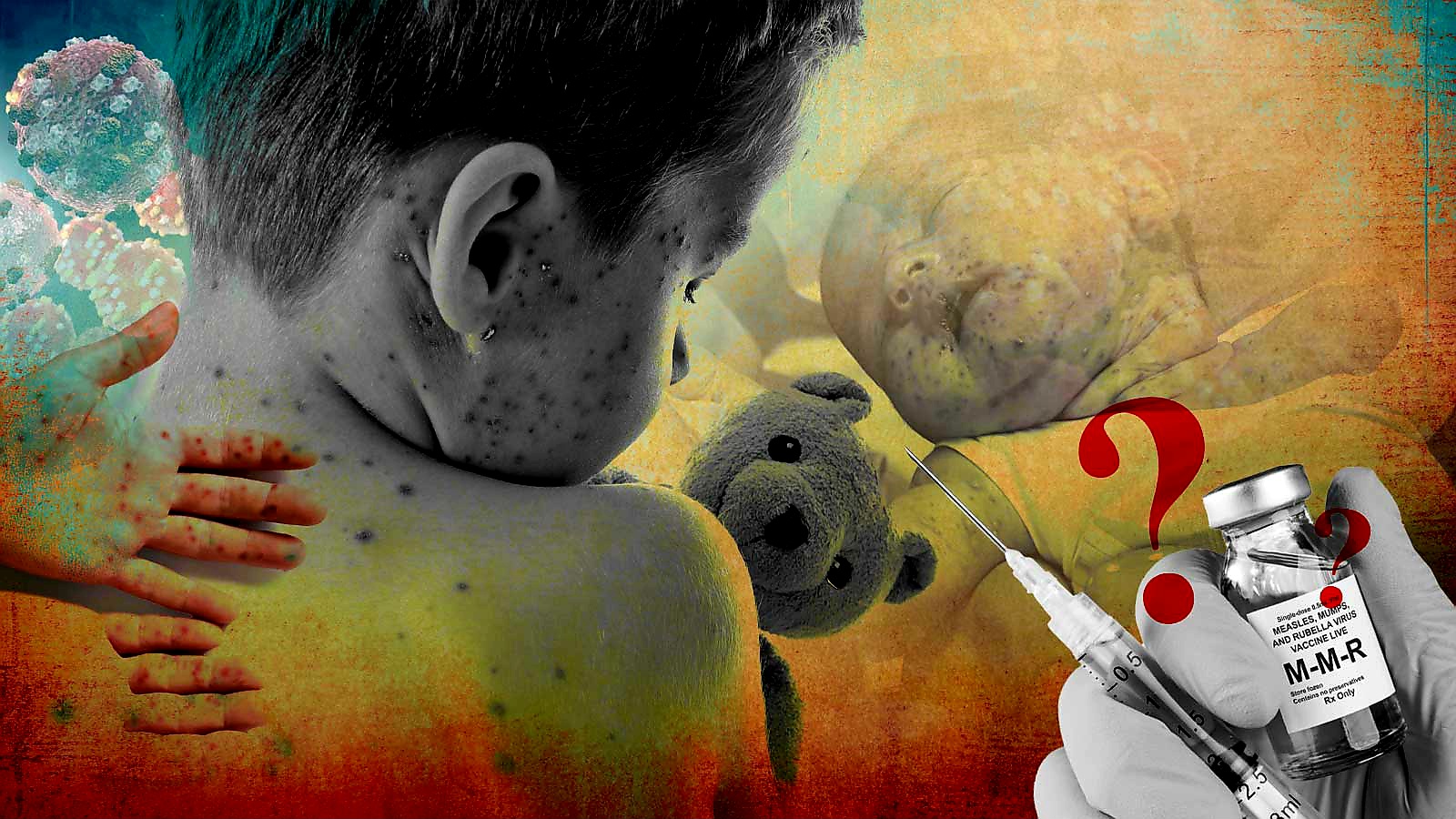 হামে আক্রান্ত শিশুদের নিয়ে কী বলা হলো